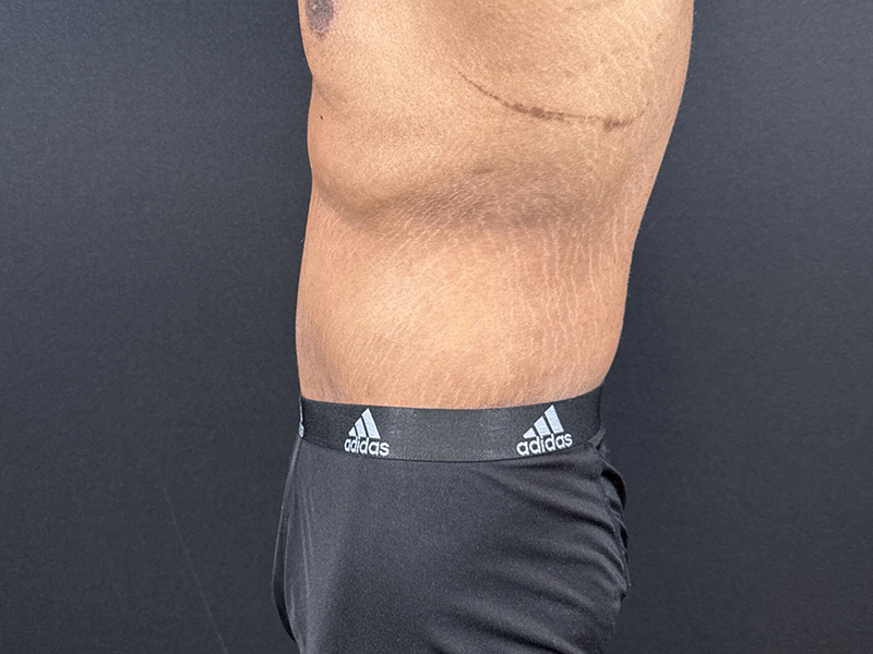 Lower-Bodiy-lift-patient-7-A3