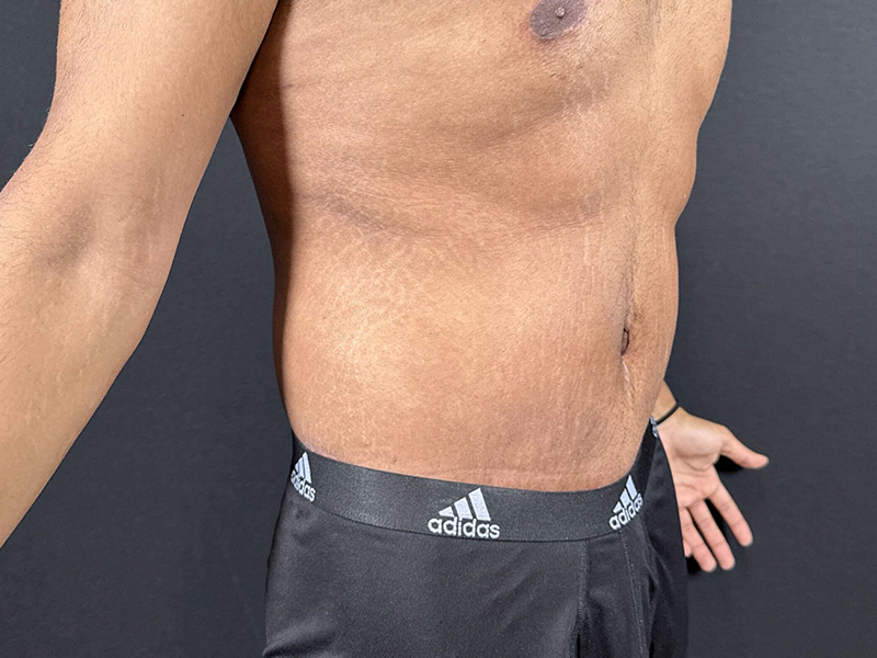 Lower-Bodiy-lift-patient-7-A4