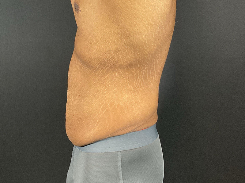 Lower-Bodiy-lift-patient-7-B3