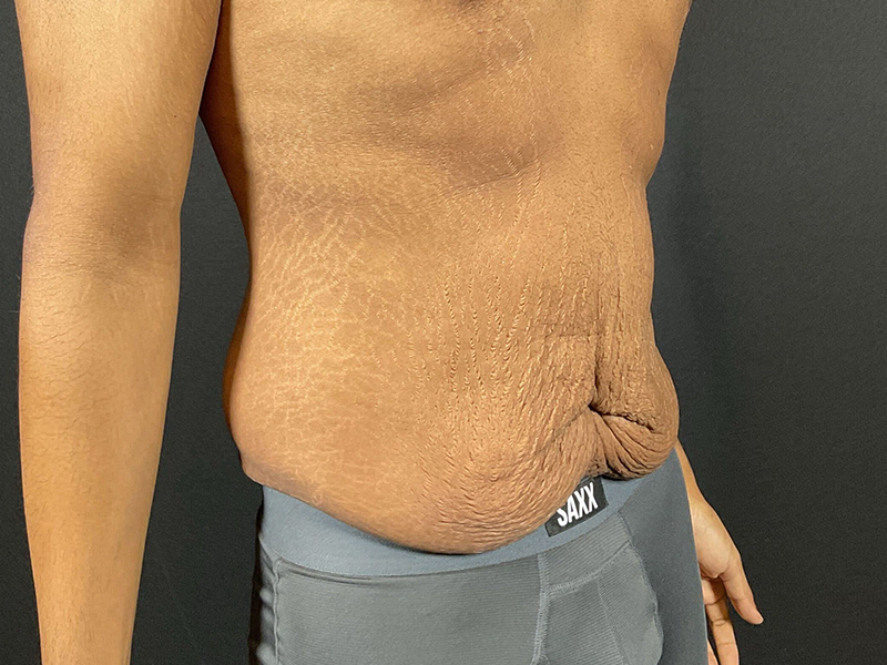 Lower-Bodiy-lift-patient-7-B4