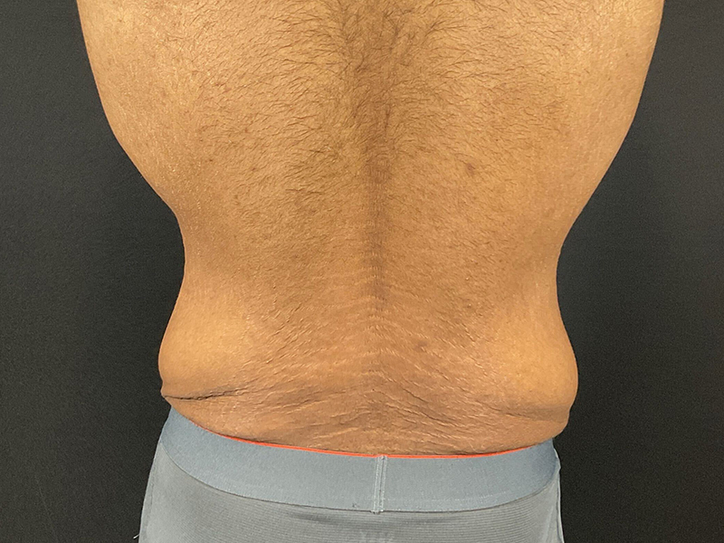 Lower-Bodiy-lift-patient-7-B6