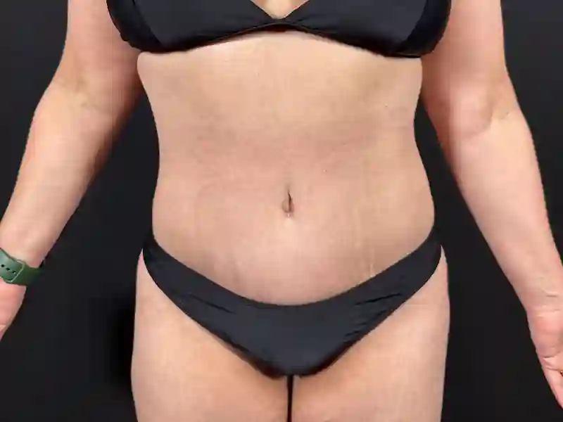 Tummytuck-23-A1