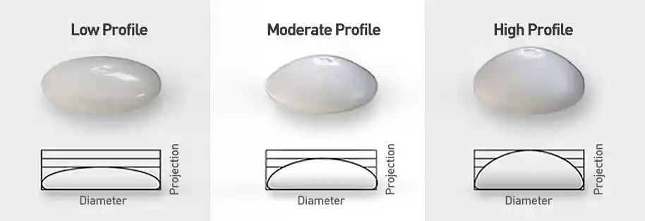 breast-augmentation-profile