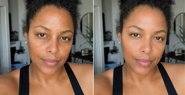 Side-by-side before and after view of under-eye filler